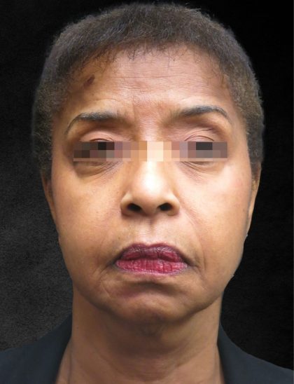 Fat Transfer Before & After Patient #1770