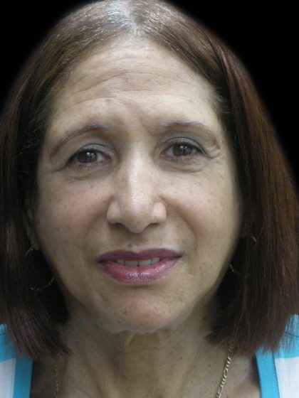 Fat Transfer Before & After Patient #1765