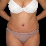 Tummy Tuck Before & After Patient #3146