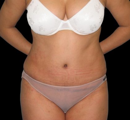 Tummy Tuck Before & After Patient #3146