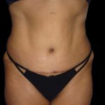 Tummy Tuck Before & After Patient #3155