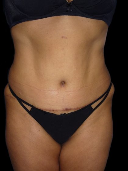 Tummy Tuck Before & After Patient #3155