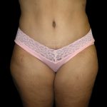Tummy Tuck Before & After Patient #3166