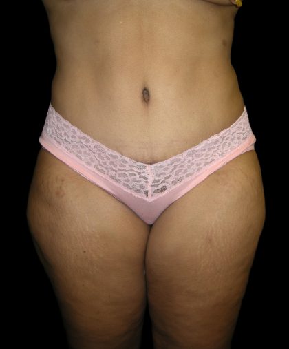 Tummy Tuck Before & After Patient #3166