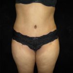Tummy Tuck Before & After Patient #3186