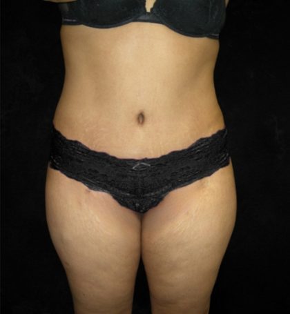 Tummy Tuck Before & After Patient #3186