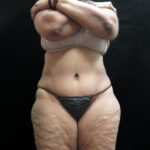 Tummy Tuck Before & After Patient #3209