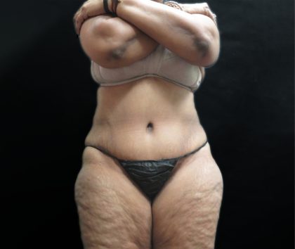 Tummy Tuck Before & After Patient #3209