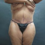 Tummy Tuck Before & After Patient #3225