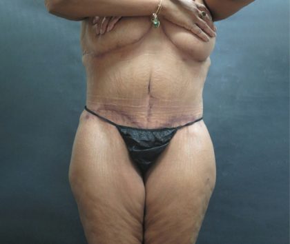 Tummy Tuck Before & After Patient #3225