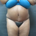 Tummy Tuck Before & After Patient #3279