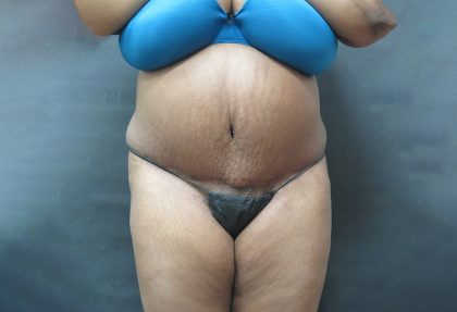 Tummy Tuck Before & After Patient #3279