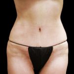 Tummy Tuck Before & After Patient #3293