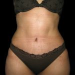 Tummy Tuck Before & After Patient #3300