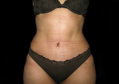 Tummy Tuck Before & After Patient #3300