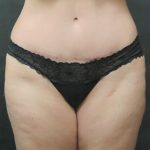 Tummy Tuck Before & After Patient #3312