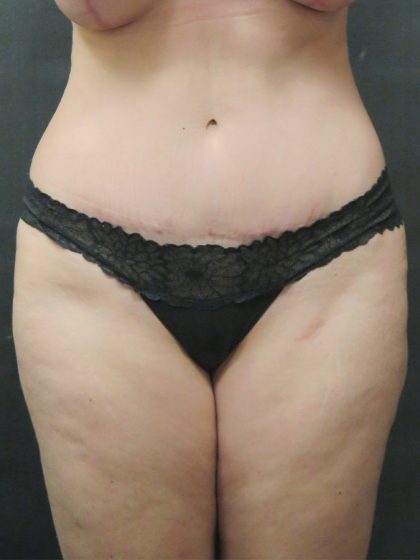 Tummy Tuck Before & After Patient #3312