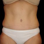 Tummy Tuck Before & After Patient #3321