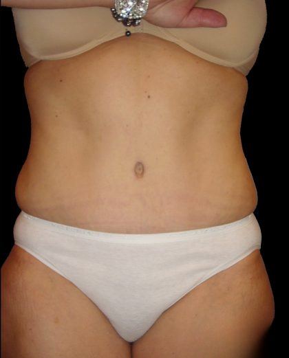 Tummy Tuck Before & After Patient #3321