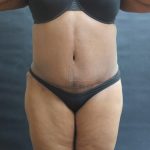 Tummy Tuck Before & After Patient #3333