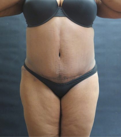 Tummy Tuck Before & After Patient #3333