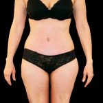 Tummy Tuck Before & After Patient #3357