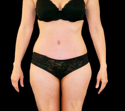 Tummy Tuck Before & After Patient #3357
