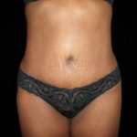 Tummy Tuck Before & After Patient #3366