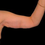 Arm Lift Before & After Patient #913