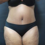 Tummy Tuck Before & After Patient #3380
