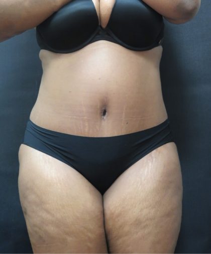 Tummy Tuck Before & After Patient #3380