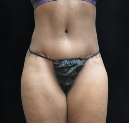 Tummy Tuck Before & After Patient #3387