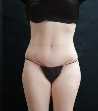 Tummy Tuck Before & After Patient #3396