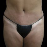 Tummy Tuck Before & After Patient #3403