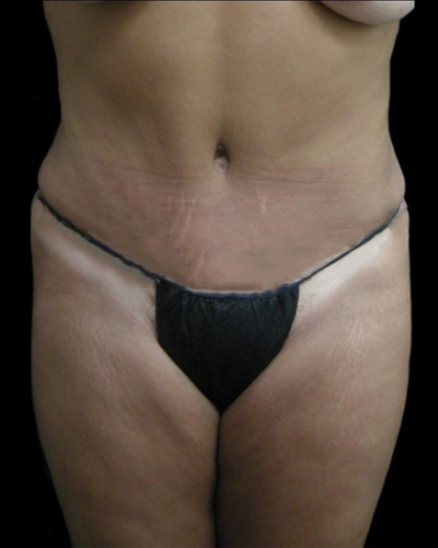 Tummy Tuck Before & After Patient #3403