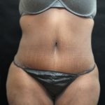 Tummy Tuck Before & After Patient #3412