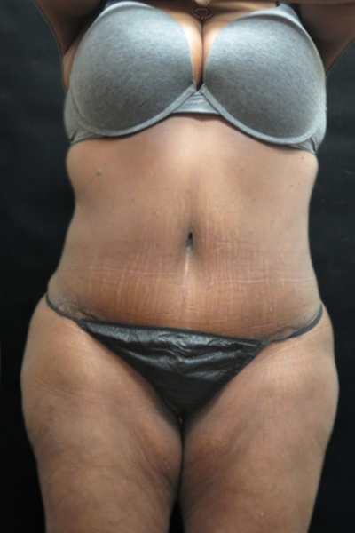 Tummy Tuck Before & After Patient #3412