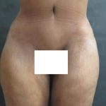 Tummy Tuck Before & After Patient #3419
