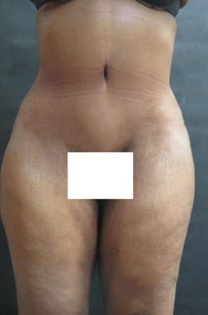 Tummy Tuck Before & After Patient #3419