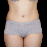 Tummy Tuck Before & After Patient #3426
