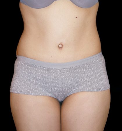 Tummy Tuck Before & After Patient #3426