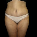Tummy Tuck Before & After Patient #3433
