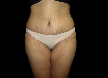 Tummy Tuck Before & After Patient #3433