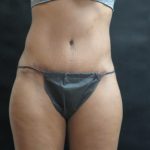 Tummy Tuck Before & After Patient #3449