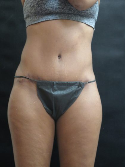Tummy Tuck Before & After Patient #3449