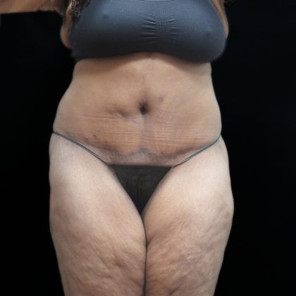 Tummy Tuck Before & After Patient #3352
