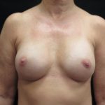 Breast Augmentation Before & After Patient #1129