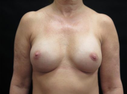 Breast Augmentation Before & After Patient #1129