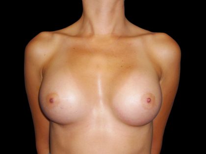 Breast Augmentation Before & After Patient #1016