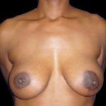 Breast Augmentation Before & After Patient #1098